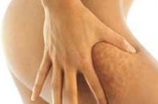 Как избавиться от целлюлита